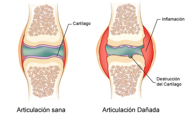 Resultado de imagen para artritis